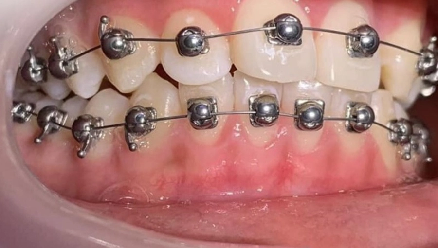 Công nghệ mắc cài cánh cam có ưu điểm gì