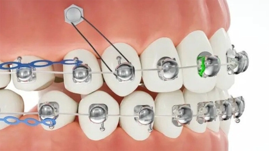 Công nghệ mắc cài cánh cam có ưu điểm gì