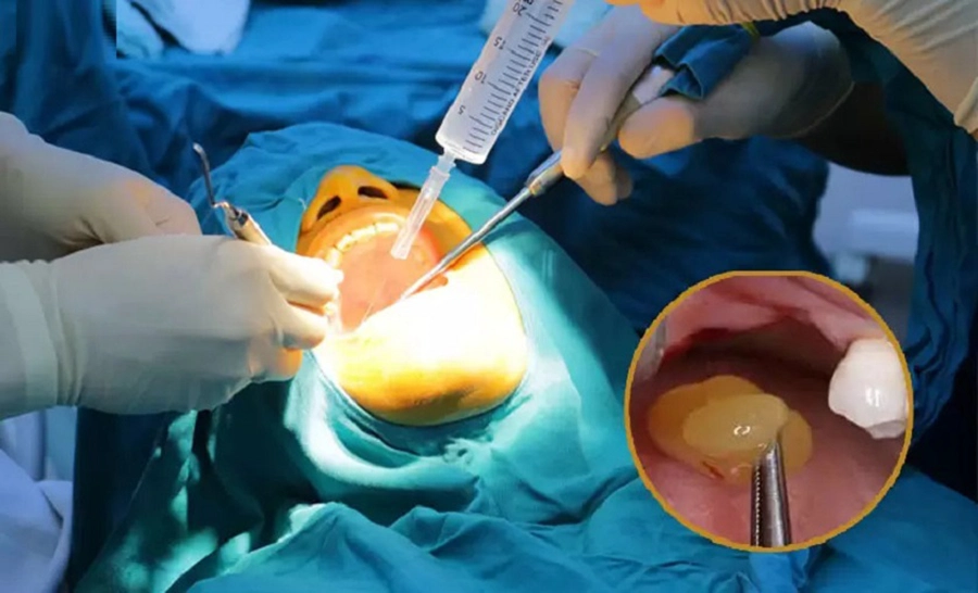 Công nghệ nhổ răng ghép PRF nhanh lành thương
