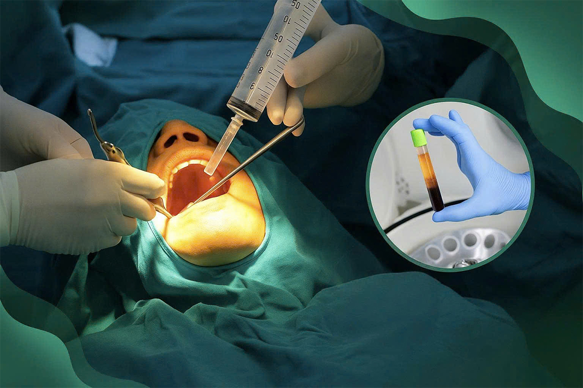 Công nghệ nhổ răng ghép PRF nhanh lành thương