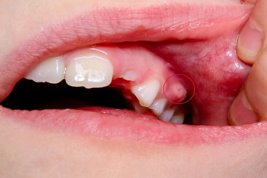 Điều trị tủy răng