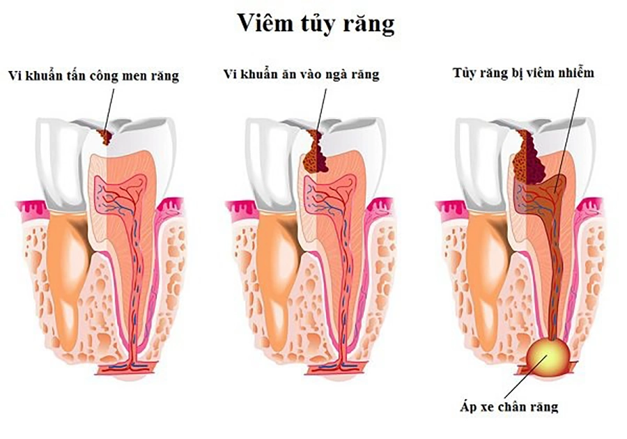 Điều trị tủy răng