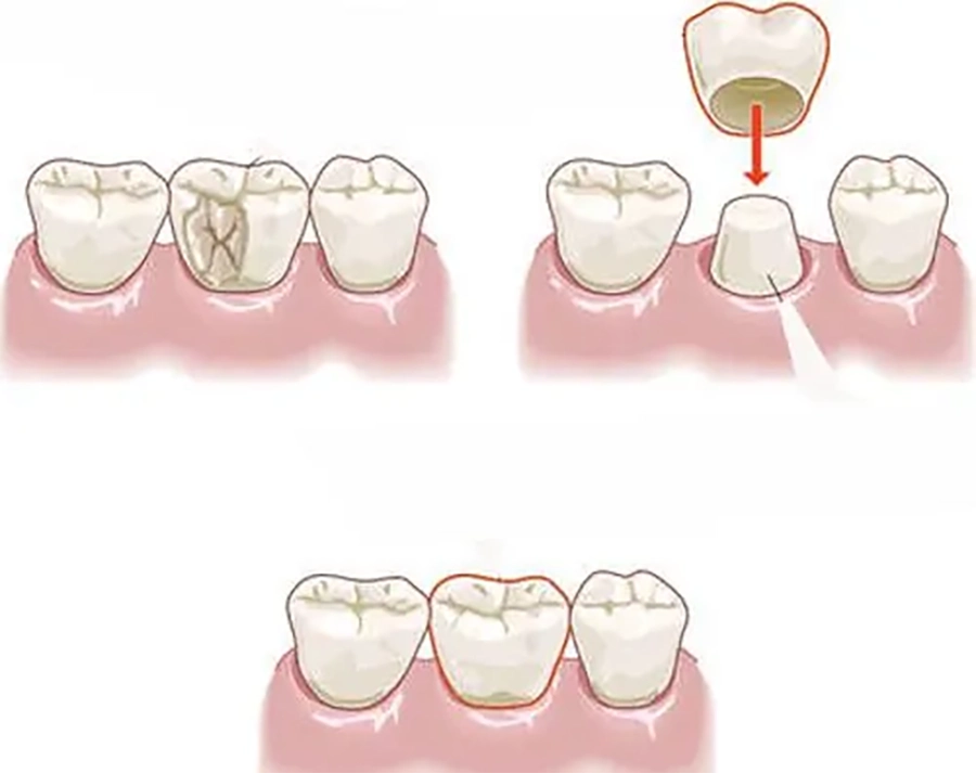 Điều trị tủy răng