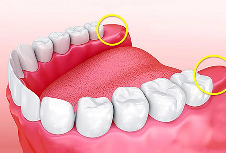 Nhổ răng khôn an toàn tại nha khoa gia đình