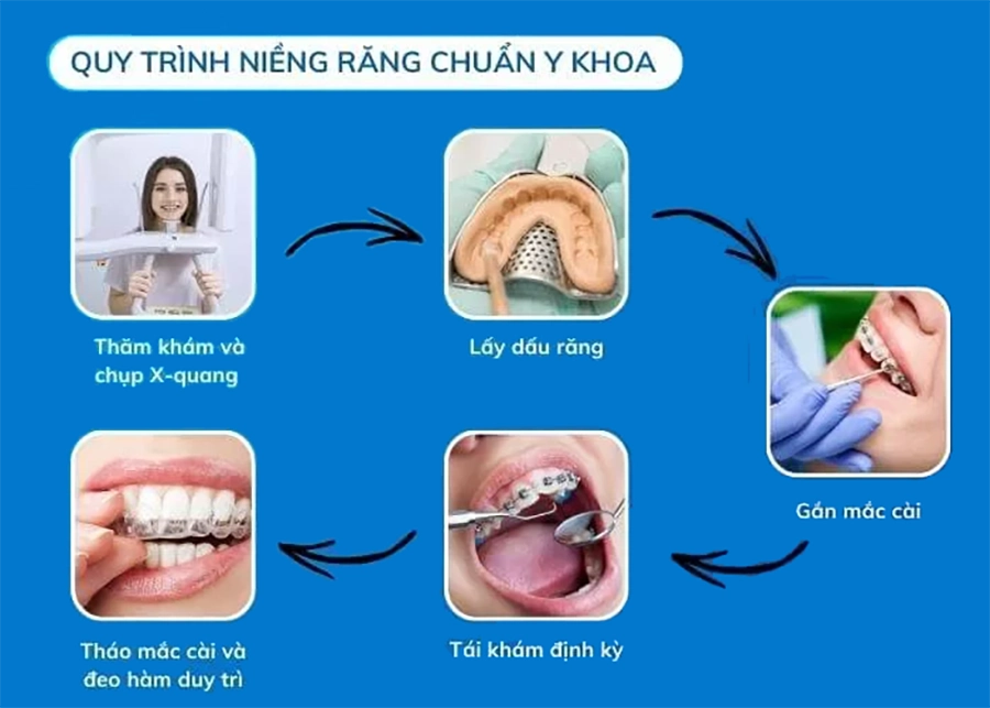 Niềng răng không mắc cài