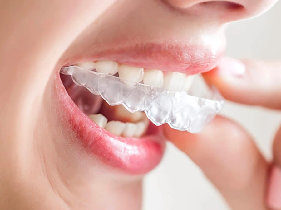 Niềng răng không mắc cài