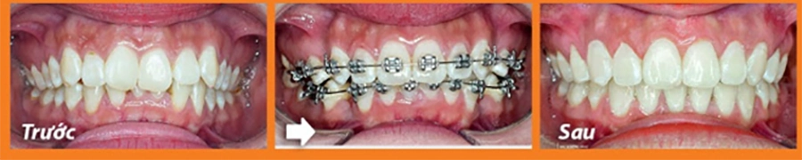 Niềng răng thẩm mỹ
