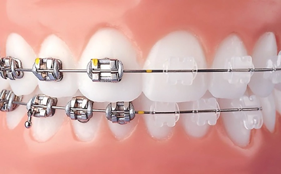 Niềng răng thẩm mỹ
