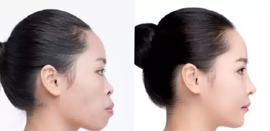 Niềng răng thẩm mỹ